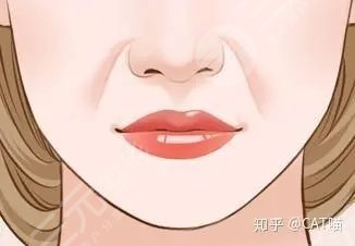 鼻唇沟