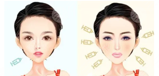 打玻尿酸,皮肤,能不能变好