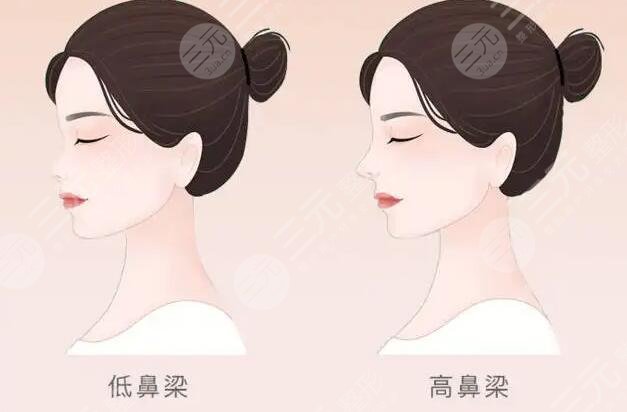 海南华美医学美容医院鼻整形案例