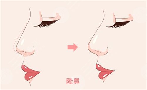 隆鼻整形都有哪些方法 隆鼻整形都有哪些方法