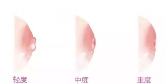乳头内陷有什么危害 如何矫正乳头内陷