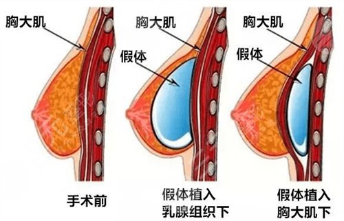 广州隆胸大概需要多少钱