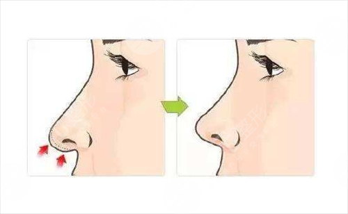 假体隆鼻术后为什么出现后遗症,都有哪些表现
