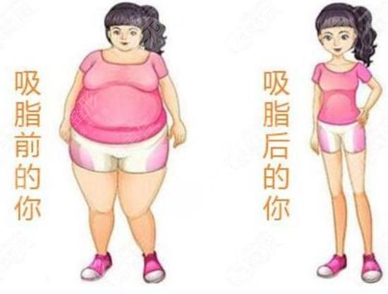 自体脂肪的用处这么多,可不止填充脸颊哦~