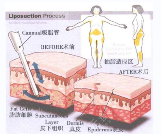 自体脂肪的用处这么多，可不止填充脸颊哦~