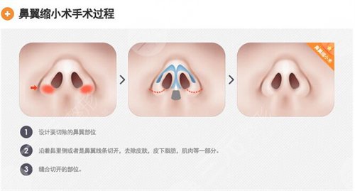 鼻翼缩小手术是永.久的吗 鼻翼缩小手术是永.久的吗