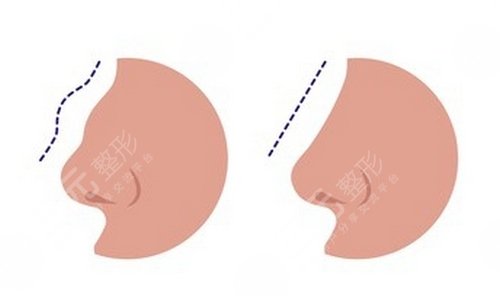 驼峰鼻矫正的方法有哪些?术后该如何护理?