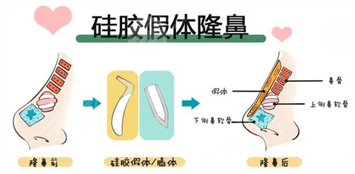 朝天鼻怎么办 朝天鼻矫正有哪些方法