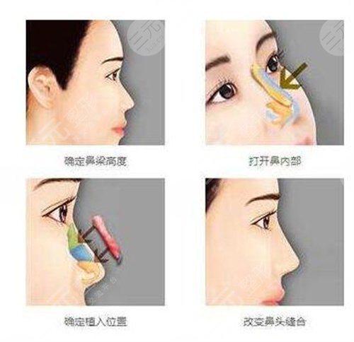 鹰钩鼻矫正术有哪些 鹰钩鼻矫正术前后果对比图