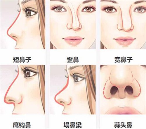鹰钩鼻矫正术前后对比 鹰钩鼻矫正前后果对比图