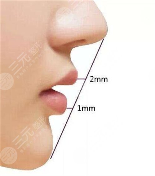 鼻翼塑型手术原理
