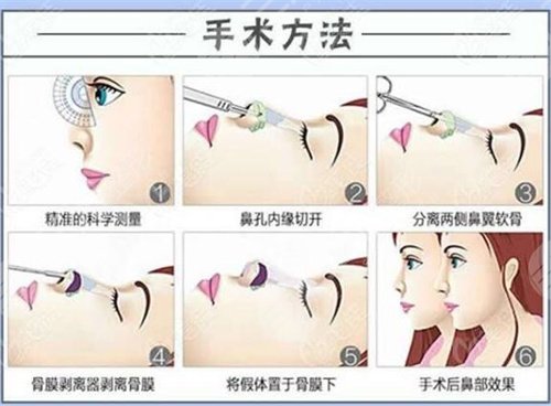 鼻翼缺损修复手术的难易程度，手术大致操作步骤