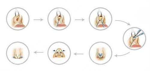 鼻翼缺损矫正手术会留疤吗？