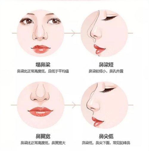 歪鼻手术的禁忌症