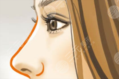 做隆鼻手术多少钱?