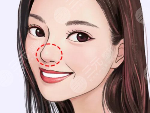 鼻子整形手术前注意事项