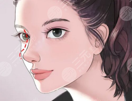 鼻子整形手术前注意事项