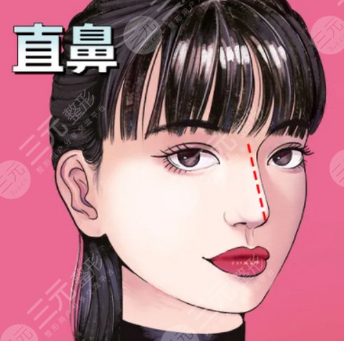 隆鼻手术的手术过程