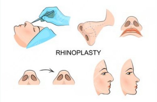 朝天鼻整形多少钱的首要因素