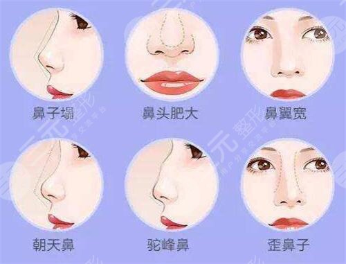 朝天鼻整形多少钱的首要因素