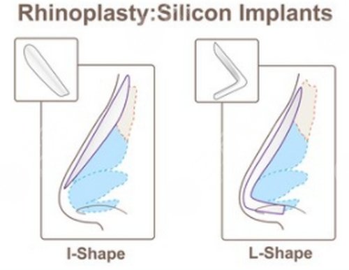 朝天鼻整形多少钱的第三因素
