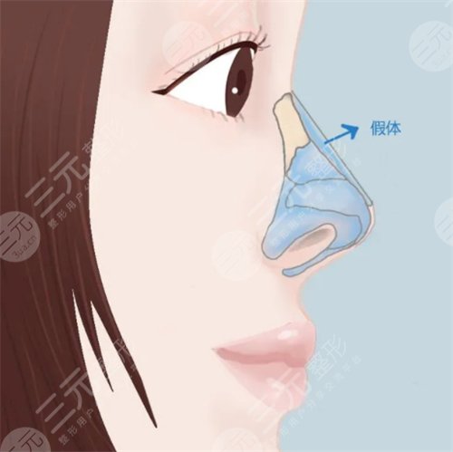 朝天鼻术后注意事项