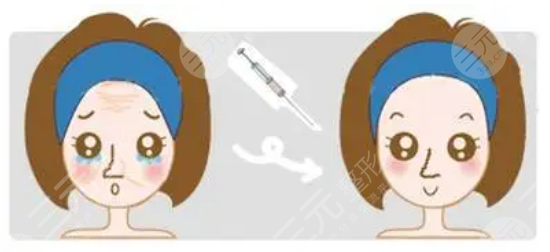 注射瘦脸除皱,需要,怎样护理
