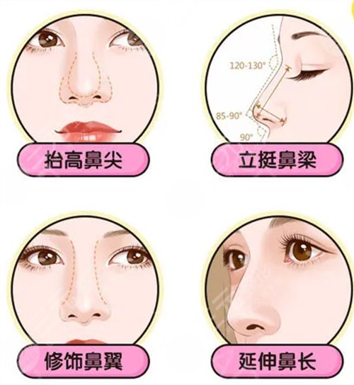 垫鼻基底恢复过程照片反馈,高挺鼻诞生过程!