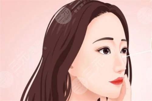 无假体隆鼻病例反馈