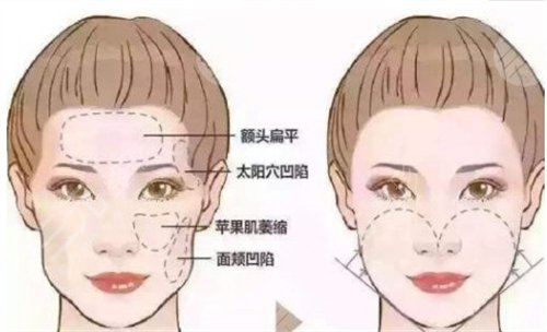鼻唇沟去除