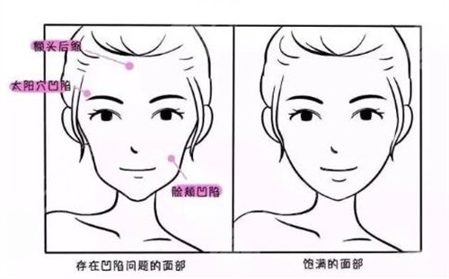鼻唇沟去除
