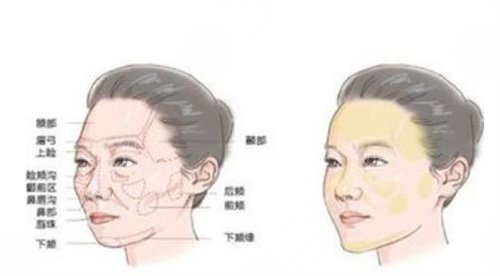 鼻唇沟去除