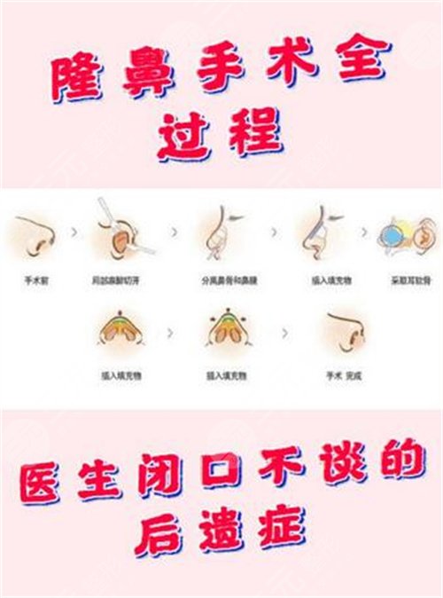 歪鼻整形方法