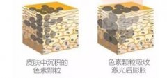 激光洗眉一到七天图片赏析,摆脱“老式眉”,重新做时尚女士! 激光洗眉一到七天图片赏析,摆脱“老式眉”,重新做时尚女士!