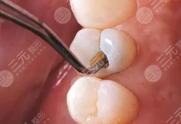 补牙