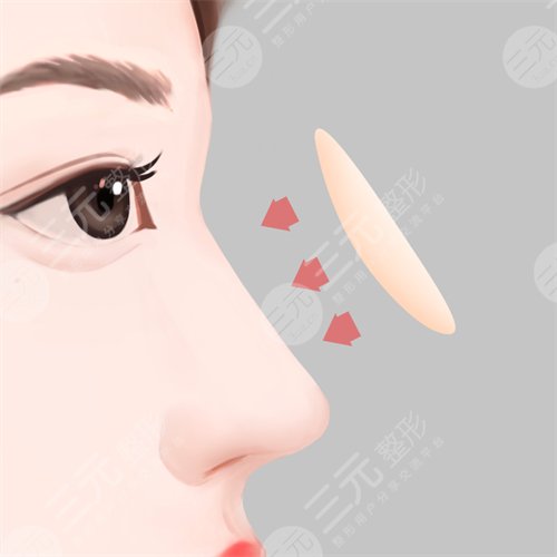 隆鼻的材料