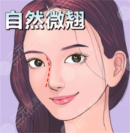 缩鼻翼手术后