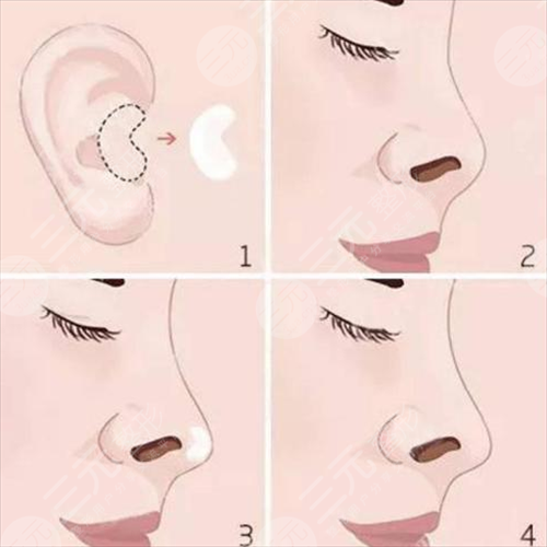 自体软骨隆鼻注意事项有哪些