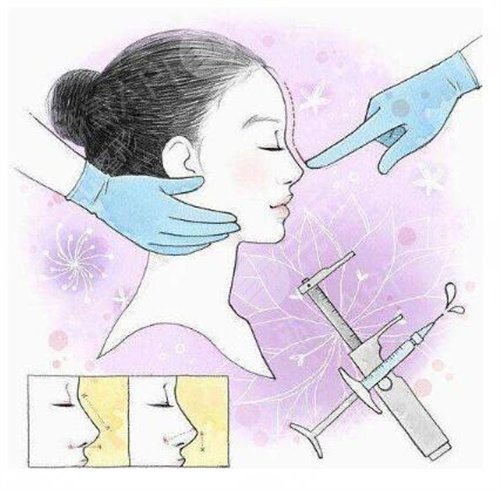 朝天短鼻整形手术原理