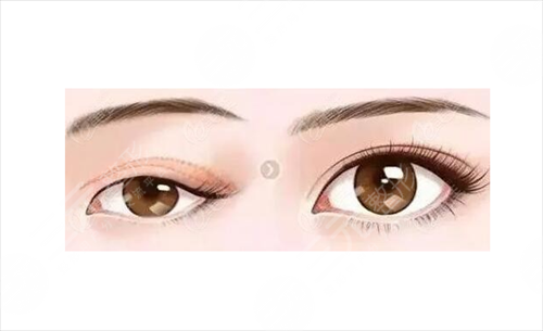 上眼皮吸脂降低风险吗?上眼皮吸脂的可靠性怎么样？