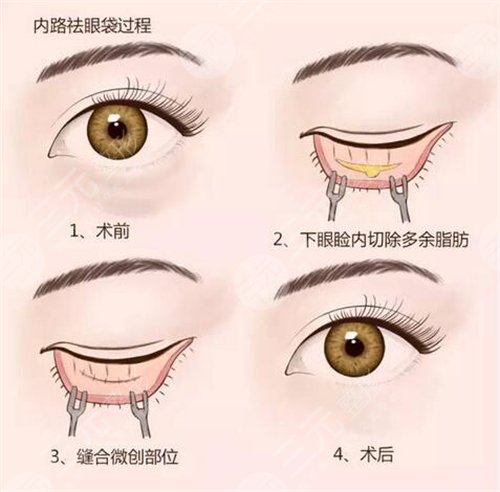 去眼袋要多少钱 去眼袋的方法有哪些