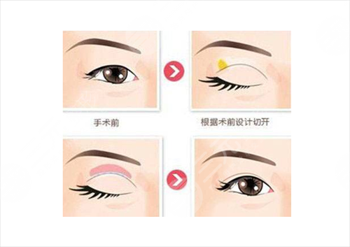 开眼角加双眼皮