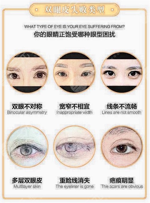 什么是双眼皮修复手术？