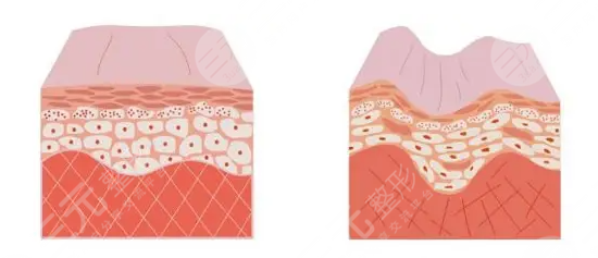 玻尿酸填泪沟多少钱？