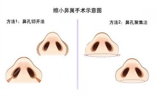 缩小鼻翼要多少钱 果怎么样