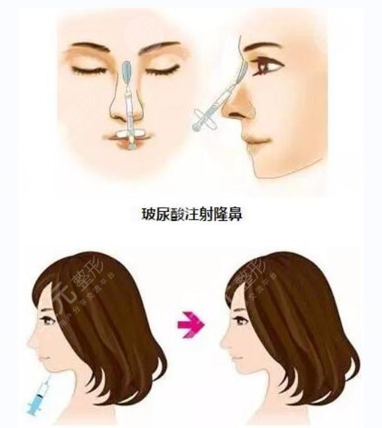 玻尿酸填充面部鼻子额头泪沟下巴需要几针? 玻尿酸填充面部鼻子额头泪沟下巴需要几针?
