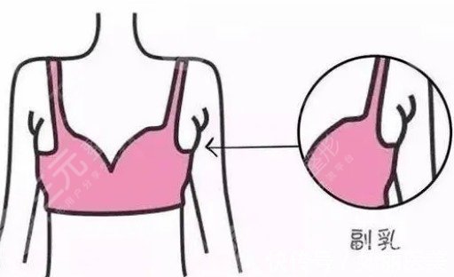 女性如果出现副乳有哪些危害? 女性如果出现副乳有哪些危害?