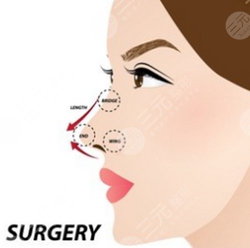 鼻尖整形手术需要恢复多久？手术有什么注意事项？