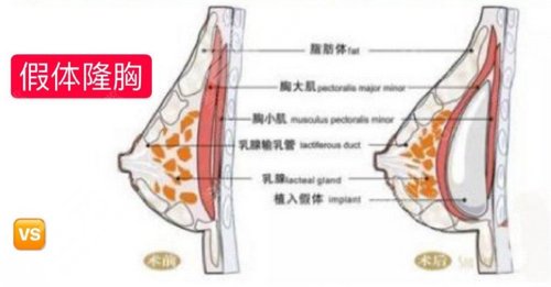 隆胸材料有哪些 隆胸用什么材料好 隆胸材料有哪些 隆胸用什么材料好