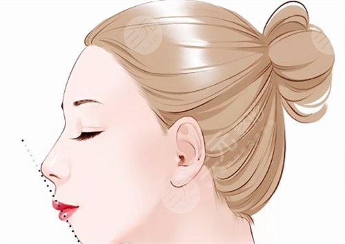 鼻部整形有什么优势？有后遗症吗？